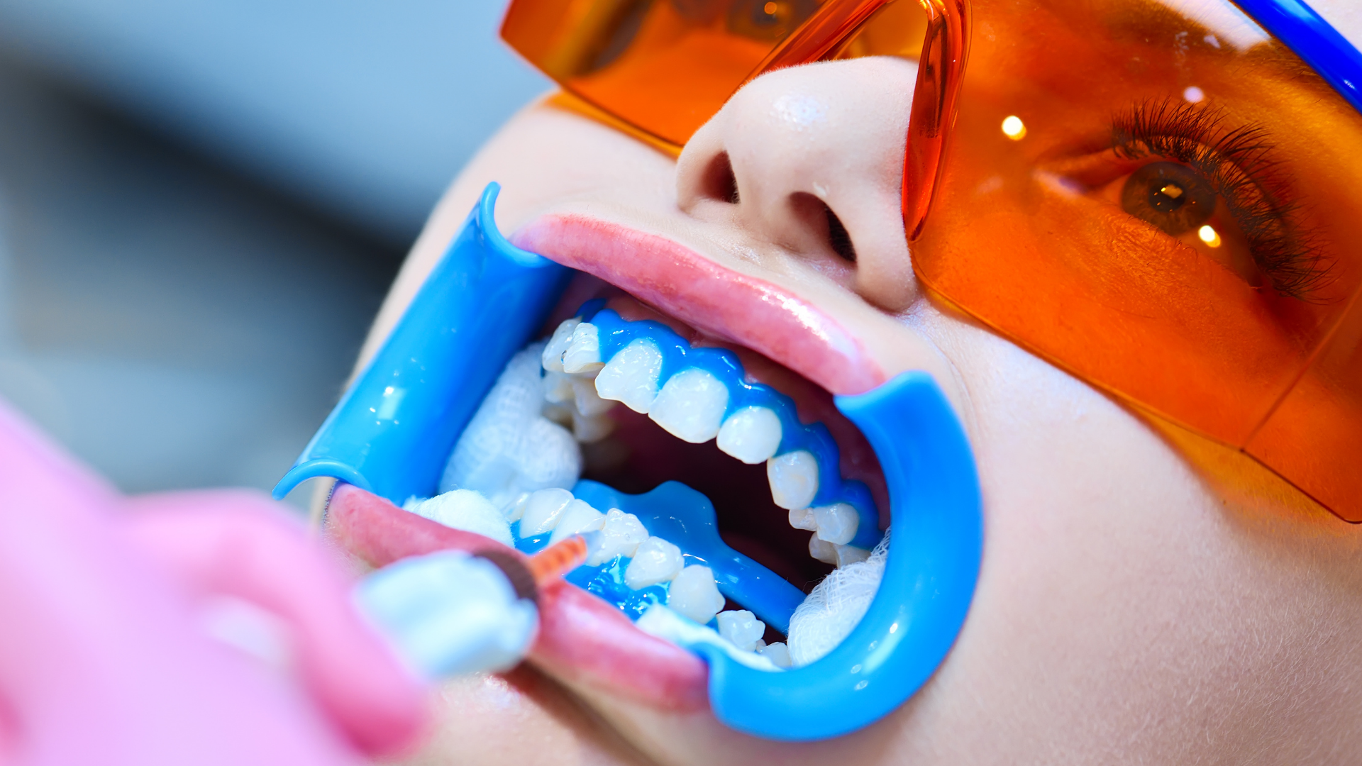 Clareamento Dental 3 13