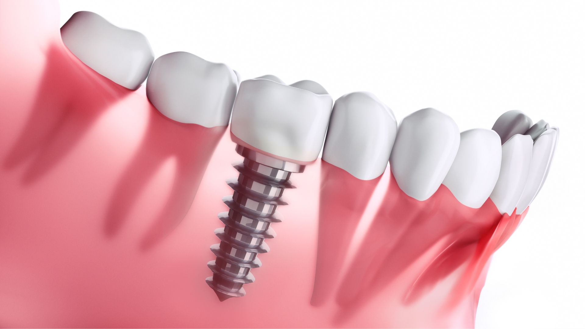 Implante Dentário 2 Implante dentário: quanto custa em média?