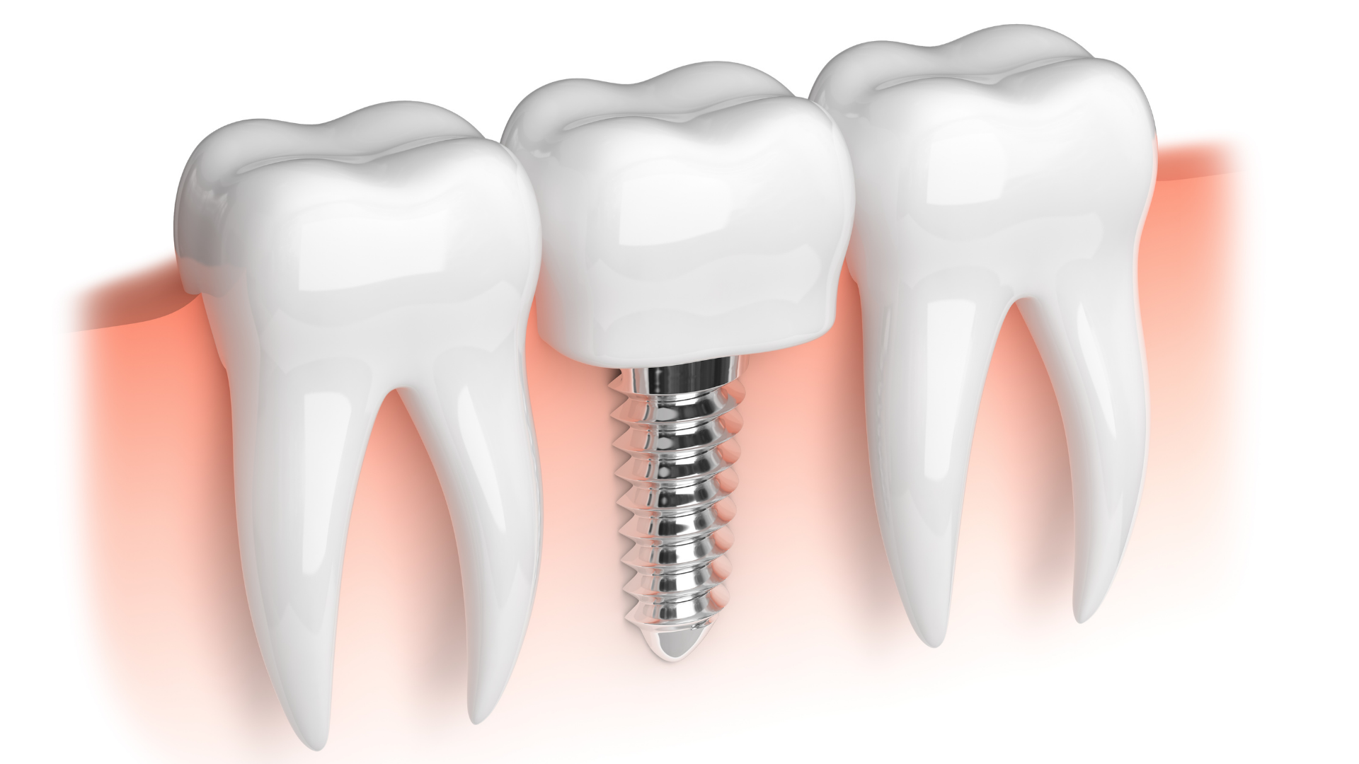 Implante Dentário 3 16