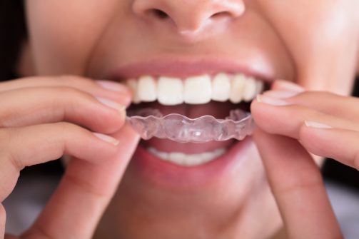 Close-up Of Woman's Hand Putting Transparent Aligner In Teeth